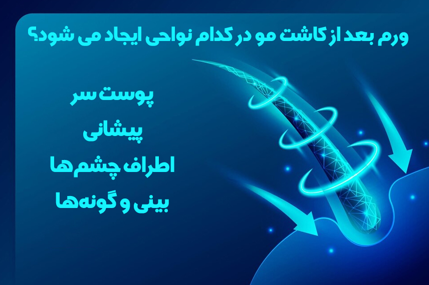 ورم بعد از کاشت مو نواحی ورم صورت بعد از کاشت مو