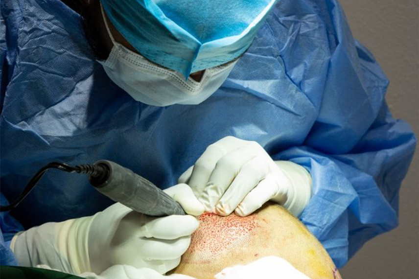 راههای پیشگیری از کاشت مو ناموفق انتخاب یک جراح مجرب و ماهر که تخصص و تجربه کافی در زمینه کاشت مو دارد، یکی از اصلیترین راههای جلوگیری از کاشت موی ناموفق است.