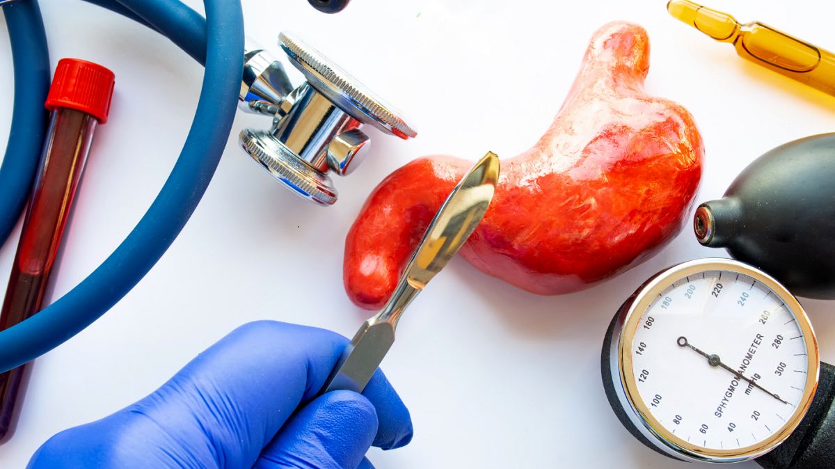 gastric-sleeve-candidates