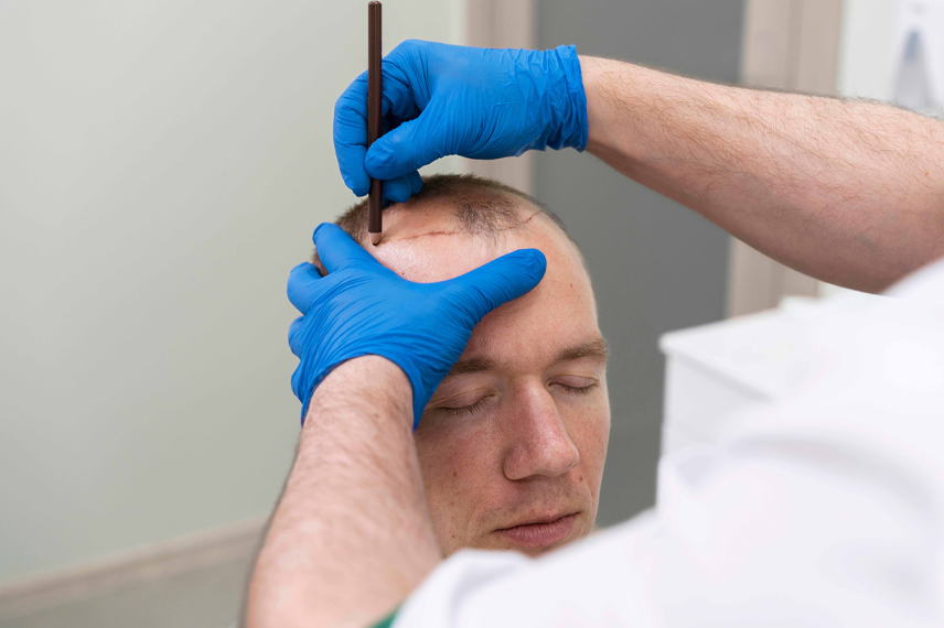 hair-transplant-preprations